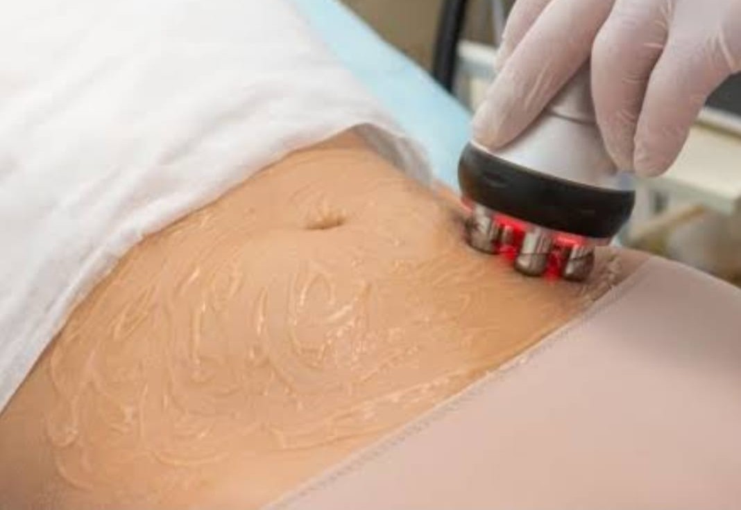 Radio Frequency handpiece being used for non-invasive fat removal and body contouring