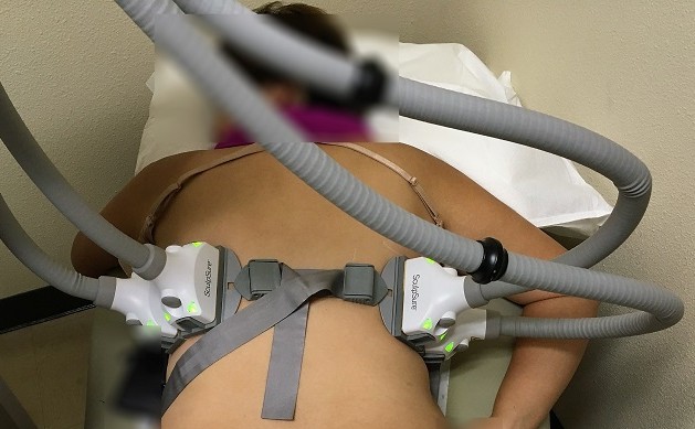 Reducing Back Fat with SculpSure